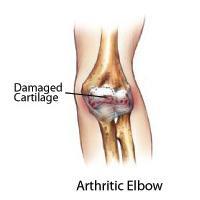 Diagnosis of Elbow Pain, Rockville, Maryland
