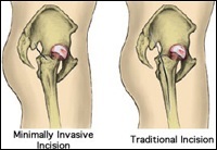 Minimally Invasive Hip Replacement, Rockville, Maryland