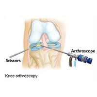 Arthroscopic Knee Surgery, Rockville, Maryland