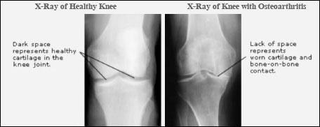 Partial Knee Replacement, Rockville, Maryland