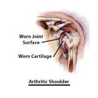 Arthritic Shoulder Treatment, Rockville, Maryland